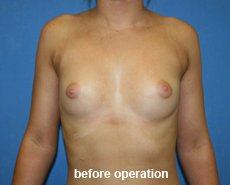 plastic-surgery-breast-augmentation